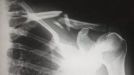 Is Skateboarding Dangerous?